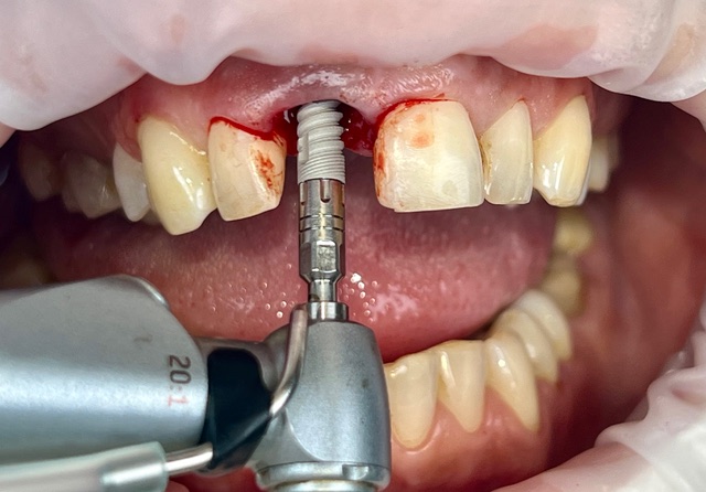 natychmiastowa implantacja