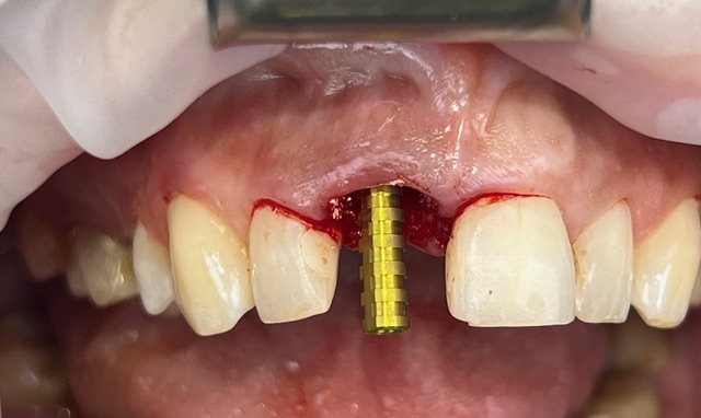 Natychmiastowe obciążenie implantu poprzez przykręcenie łącznika tymczasowego