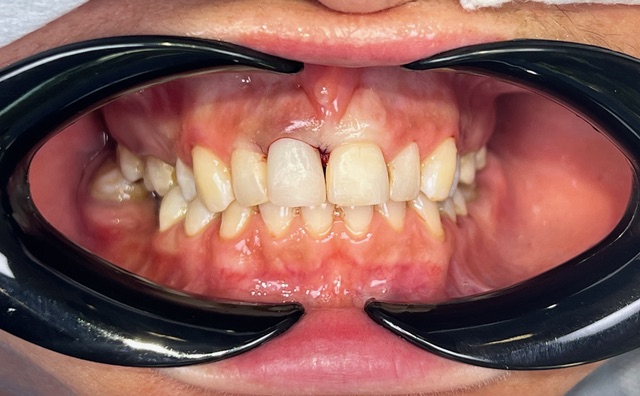 Korona tymczasowa - zęby w 1 dzień