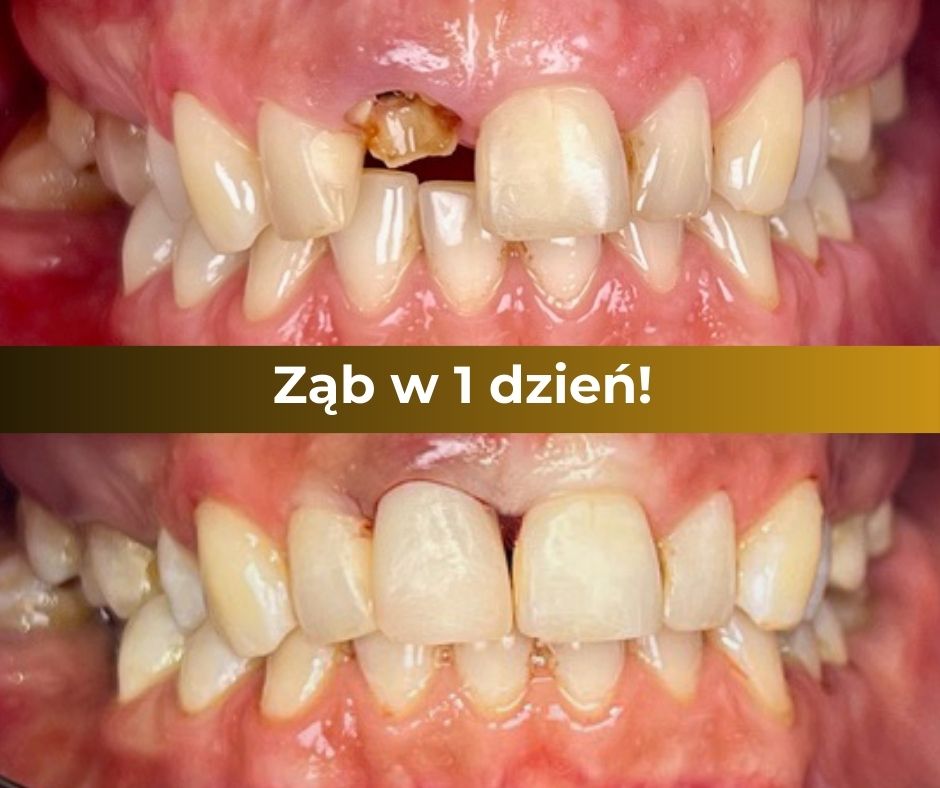 Zęby w jeden dzień