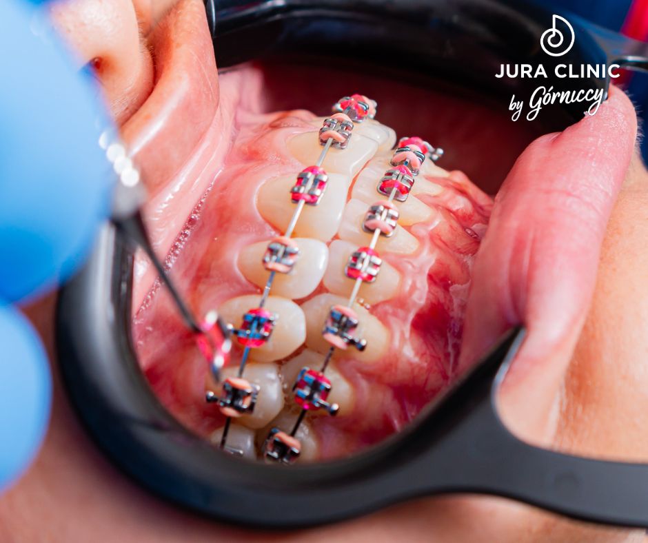 Aparat ortodontyczny