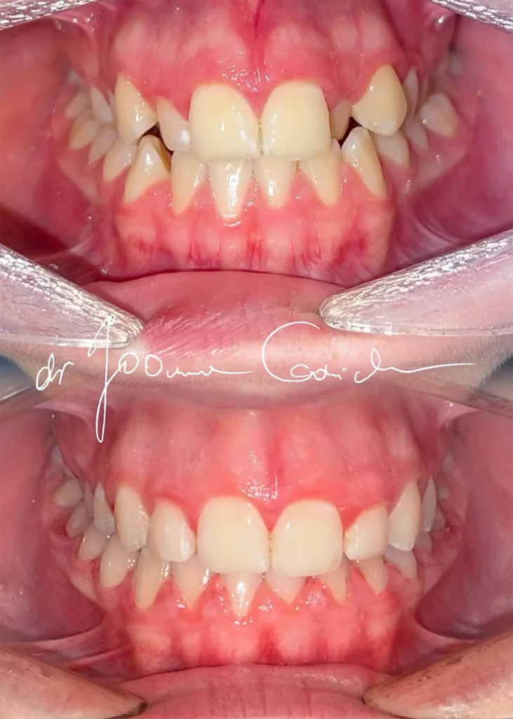 przed i po ortodoncja 1