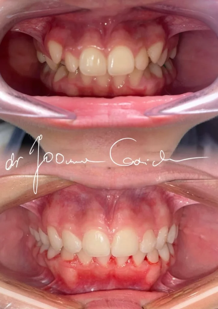 przed i po ortodoncja 3