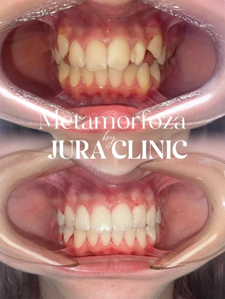 metamorfoza jura clinic ortodoncja