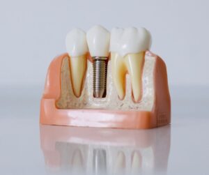 Dlaczego implant zęba nie zawsze się przyjmuje