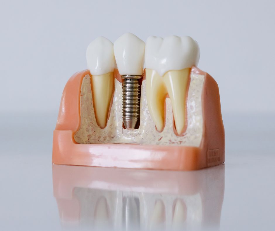 Dlaczego implant zęba nie zawsze się przyjmuje