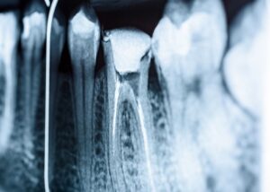 reendo - powtórne leczenie kanałowe - Jura Clinic Wolbrom