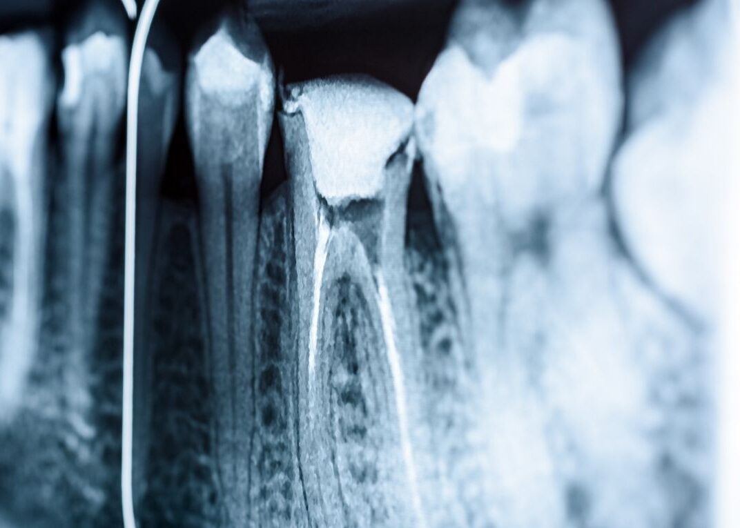 reendo - powtórne leczenie kanałowe - Jura Clinic Wolbrom