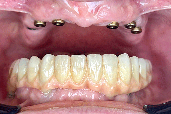 13-przed-metamorfoza-implantlogiczna